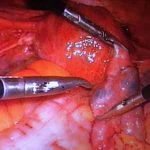 子宫内膜异位症不要再用任何药