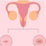 【典型】胎囊掉入阴道是怎么回事?