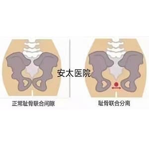 耻骨联合分离痛