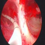 子宫纵隔是怎么得的?子宫纵隔生下来就会有吗?