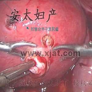 子宫肌瘤