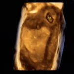 输卵管间质部妊娠（宫外孕）的图片展示