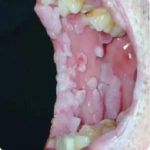 hpv感染症状有哪些呢？