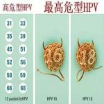 人乳头瘤病毒(HPV)常见的类型