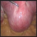 腹腔镜下肌瘤切除进行时,请看什么叫“兵不血刃”呢?