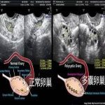 多囊卵巢做了试管婴儿后会得到孩子吗?