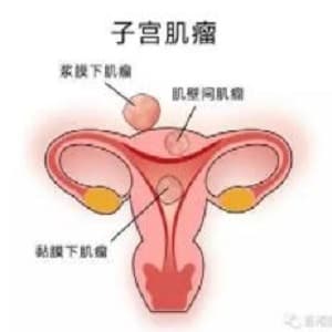 子宫肌瘤