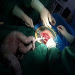 羊水栓塞的预防与MER环