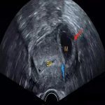 她因为宫外孕选择在北京安太医院保管手术