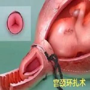 宫颈环扎