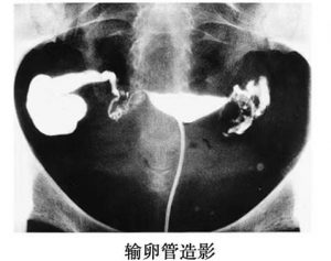 输卵管检查的具体方法有哪些？-陈凤林
