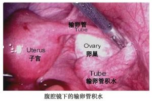 输卵管积水