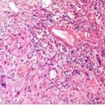 宫颈原位癌王女士获救纪