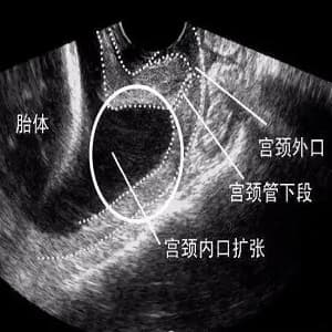 好不容易怀到六个月发生了流产这是为啥（宫颈短）?