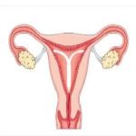 子宫腺肌瘤带的环效果好不好？