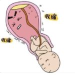 生完孩子尿失禁怎么办?