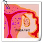 怎样治疗子宫腺肌症效果好呢?