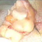 畸胎瘤案例之-7岁侏儒腹内惊现”老人头”