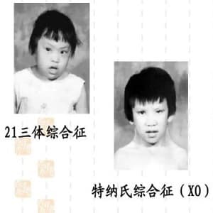 先天性卵巢发育不全/特纳氏综合征/45,XO