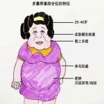 多囊卵巢综合症肥胖能吸脂吗?陈凤林