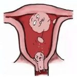 子宫上长了子宫肌瘤不治疗怀孕会有什么影响?陈凤林