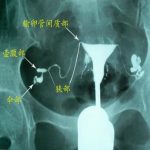 常用的输卵管通畅检查有哪些呢?