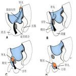 隐睾的诊断与治疗-陈凤林