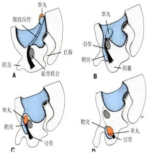 隐睾
