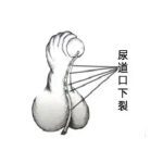 把尿道下裂当成石女治会有什么后果？