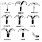 子宫畸形-子宫发育异常概述