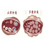 不排卵原因多多 介入刺破单刀直入