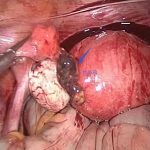 【观点】相比治疗宫外孕找病因更关键！