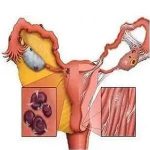 盆腔粘连为啥会导致不孕呢?