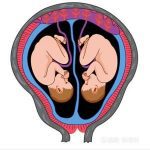 六个月双胎试管婴儿因为何而流产？