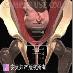  宫颈埋箍与宫颈环扎术的对比