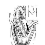 产后便秘为直肠前壁空虚导致