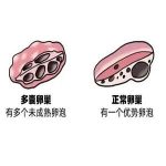 多囊卵巢综合症病因与卵睾异位有关