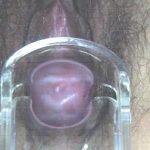 墙角阴道复位术后无须带模具