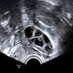 【不孕案例】北京安太医院挽救农家女的故事