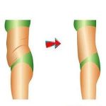 【疑问】多囊卵巢综合症“吸脂”有何讲究？