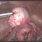 【奇迹】22个子宫肌瘤安太保宫历时7小时