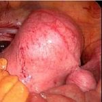 【视频】子宫腺肌症的她剧烈痛经多年来北京保宫！