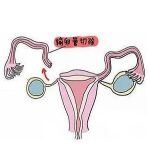 哪边排卵就是通过哪条输卵管受孕吗?