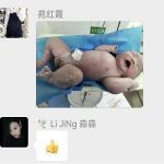 【喜讯】宫颈埋箍术后足月生三胎@儿子重十斤半