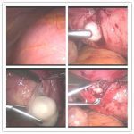 【坚定】巨大子宫肌瘤保宫计划成功！