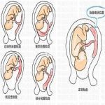 前置性胎盘来北京安太医院求治