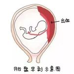 【疾病解说】胎盘早剥