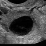 【误诊】卵泡黄素化不破裂综合征(LUF)  误以为卵巢癌
