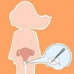 无阴道有子宫特色技术-人工子宫脱垂阴道成型