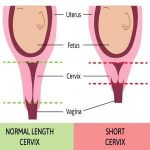宫颈松弛的病因及确诊方法
